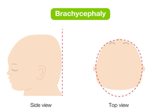babies with plagiocephaly, brachycephaly, and dolichocephaly showing head shape deformities, top and side view