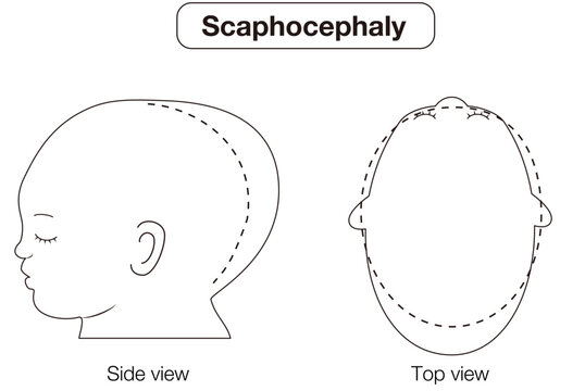 Black and White Line Illustration of Infant Head Shape Deformities &ndash; Plagiocephaly, Brachycephaly, and Dolichocephaly (Top and Side Views)