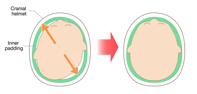 Diagram explaining helmet therapy for plagiocephaly with cranial correction through guided growth