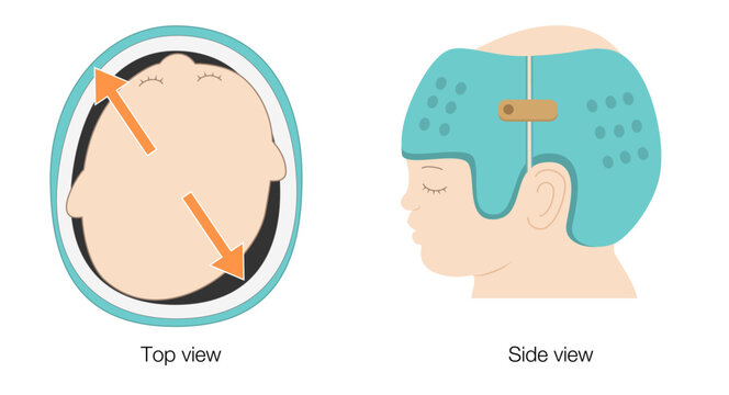 Diagram explaining helmet therapy for plagiocephaly with cranial correction through guided growth