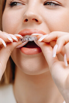 Young woman inserting a clear dental aligner for teeth alignment and oral care in a close-up beauty portrait