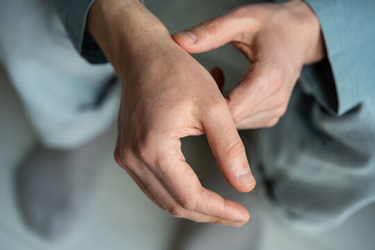 Healthcare and skin changes, male showing hands with serious body dehydration symptoms in winter season, cold frosty weather causing uncomfortable effects of frostbite and skin dryness with redness.