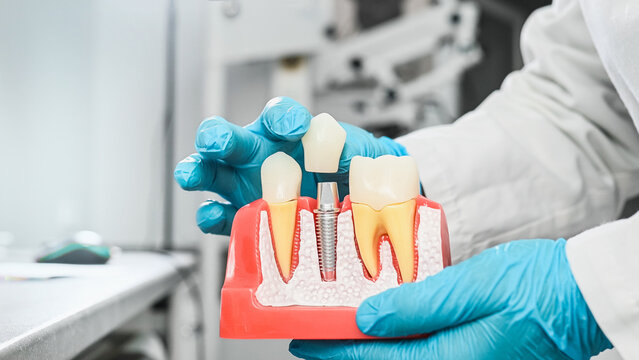 A dentist wearing sterile gloves holds an anatomical model with dental implants. Dental implant placement methods and types: endosteal and subperiosteal