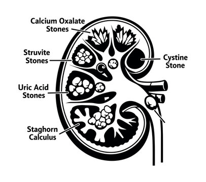 Human kidney cross section illustrating common types of renal calculi: calcium oxalate, struvite, uric acid, cystine, and staghorn