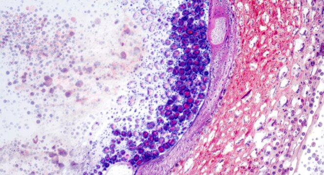 Microscopic view of desquamated squamous cells from oral mucosa with dense blue bacterial colonies on right cell using HE stain