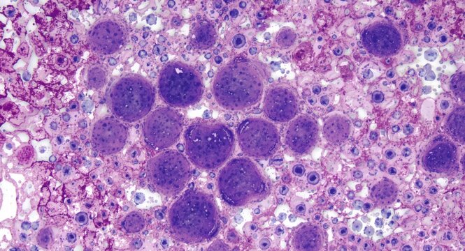 HE stained liver micrograph showing hepatocytes with polyploid features including multiple nuclei and nucleus hypertrophy