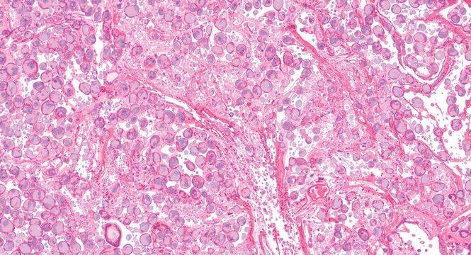 Histopathology slide featuring cytoplasmic clearing and detailed blood vessel branching characteristic of clear cell renal carcinoma