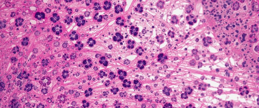 Histological diagnosis of breast cancer through microscopy of HE stained ductal carcinoma and adenocarcinoma tissue