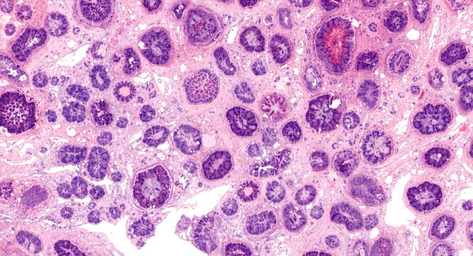 Liver histopathology slide stained with H and E emphasizing macrovesicular steatosis in hepatocyte cytoplasm