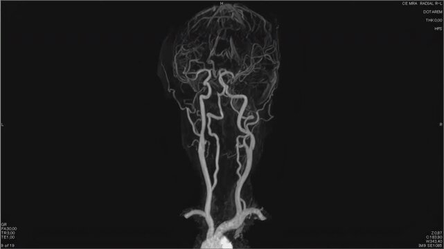 Magnetic resonance images of the brain, MRI of the brain, of a patient with multiple vascular infarctions, contrast study of the vessels of the brain and neck, black and white animation Seamless Loop