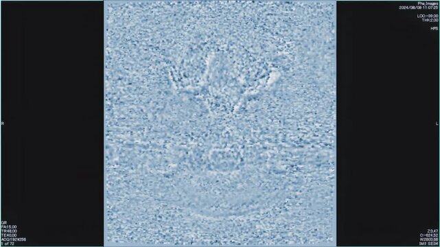 Magnetic resonance PHA images of the brain, MRI of the brain, of a patient with multiple vascular infarctions, top view, monochrome animation Seamless Loop
