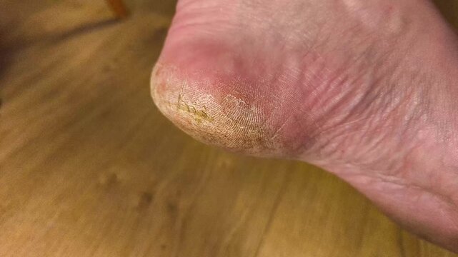 Authentic real life extreme close-up of a dry severely cracked heel on an elderly person foot dermatology healthcare and medical foot care problem real footage no ai