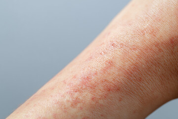 Fototapeta premium Human skin affected by scabies rash with red and irritated texture and small spots