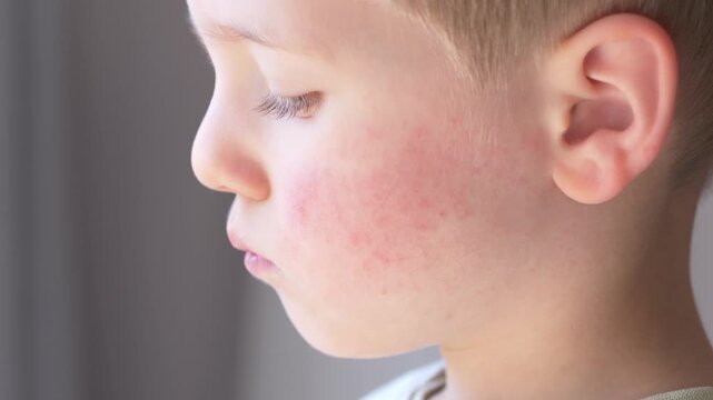 Child profile with red cheeks and rash showing allergy, atopic dermatitis, parvovirus B19 or erythema infectiosum. Pediatric dermatology concept with treatment. Little boy with facial redness.
