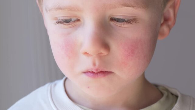 Close up of child with red cheeks and rash showing allergy, atopic dermatitis, parvovirus B19 or erythema infectiosum. Pediatric dermatology concept with treatment creams and skincare. 