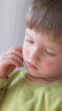 Little boy touching itchy face showing rash and discomfort. Child health concept highlights allergic reaction, viral infection and dermatological care with creams. 