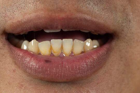 Yellow teeth, gums, and tartar.