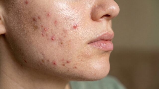 Close-up of a person's face showing acne, pimples, and other skin problems. Focus on dermatology and skin health