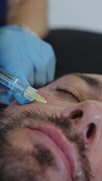 This close-up view captures a medical doctor specialized in aesthetic medicine, performing a precise intradermal injection of polynucleotides on a male patient.