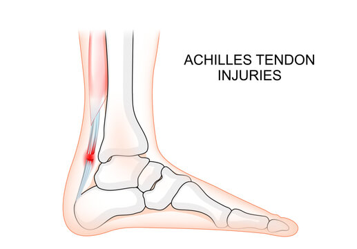 Achilles tendon Injuries. Human foot with bones and Achilles tendon.