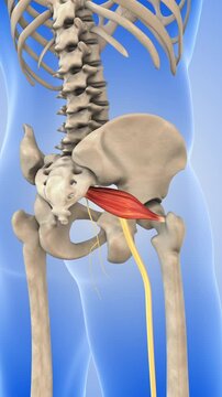 Tight Piriformis Muscle Irritating Sciatic Nerve