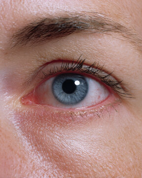 Hyperthyroidism can cause bulging eyes as one of symptoms, often leading to noticeable changes in eye appearance and discomfort in affected individuals