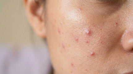Naklejka premium Facial acne on cheek with inflamed red spots in closeup portrait