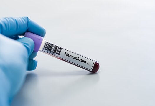 Blood sample tube for hemoglobin E test analysis.