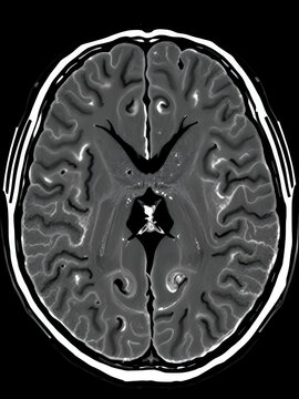 Brain CT image revealing significant intracerebral and sulcus hemorrhage necessitating urgent craniectomy