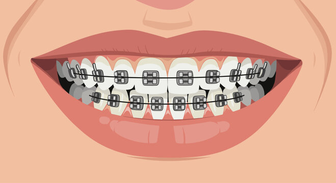 Close-up of a human smile with metallic dental braces on teeth for orthodontic treatment and straight smile alignment.