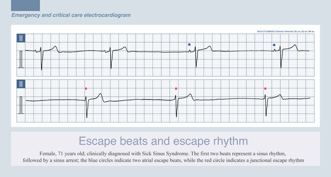 During slow ventricular rhythms, various escape beats and escape rhythms may sometimes occur, including atrial, junctional and ventricular escape beats and their corresponding rhythms.
