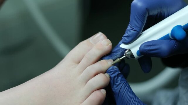 A close-up of a foot with a fungus on the nails is examined by a doctor in gloves. Onycholysis: detachment of the nail from the nail bed. High quality 4k footage
