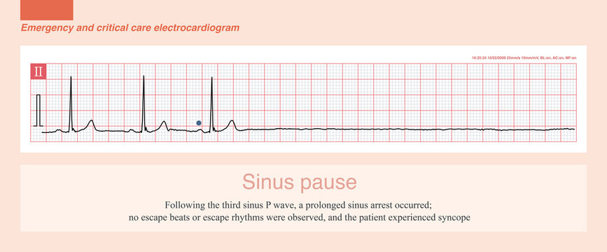 In the event of a sinus arrest, if an escape beat and escape rhythm fail to occur in a timely manner, the patient will experience symptoms of syncope.

