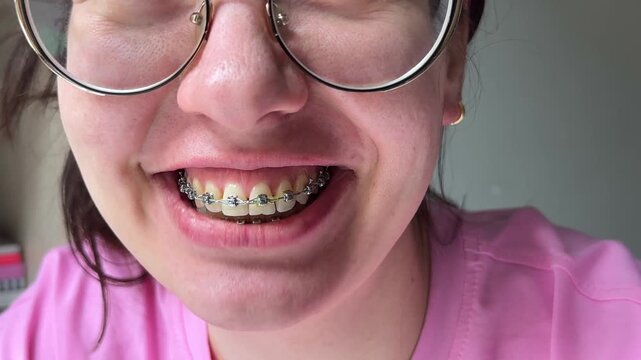 Close Up Smiling Woman With Braces, Glasses And Pink Shirt. Candid Athome Orthodontic Vlog Showing Metal