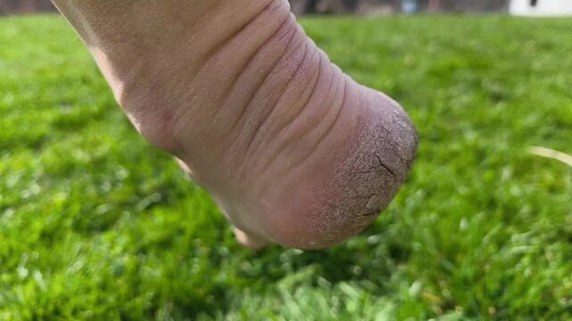 Cracked heel on an elderly person foot extreme close-up authentic real life photo dry skin dermatology healthcare and medical foot care problem no ai