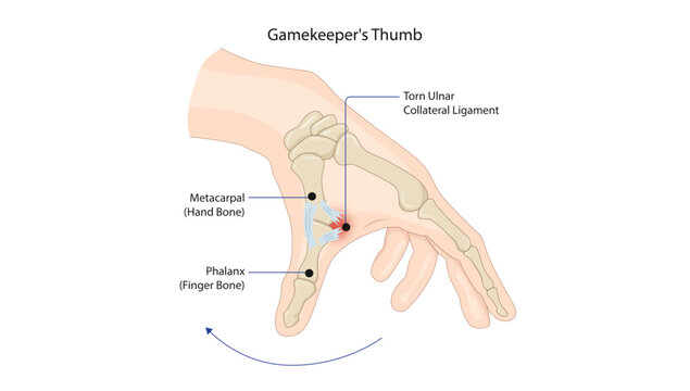 Gamekeeper's Thumb
Injury of the ulnar collateral ligament of the thumb at the metacarpophalangeal joint, usually caused by forced thumb abduction.