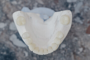 Dental model of upper jaw with artificial teeth on a textured surface © bo.kvk