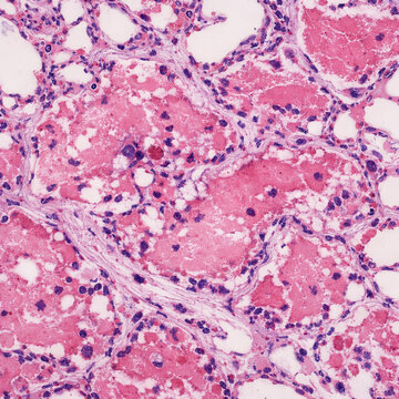 ARDS Diffuse alveolar damage in lung histology