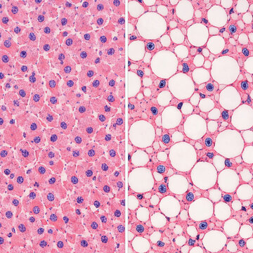 Normal liver versus steatotic liver histology