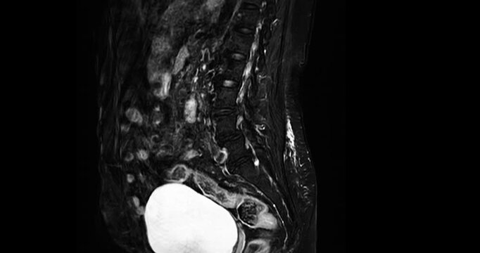 Medical video footage of an MRI lumbar spine scan revealing lumbar spondylosis and a herniated disc at the L3-L4 level. Perfect for healthcare, neurology, and orthopedic diagnostic concepts.