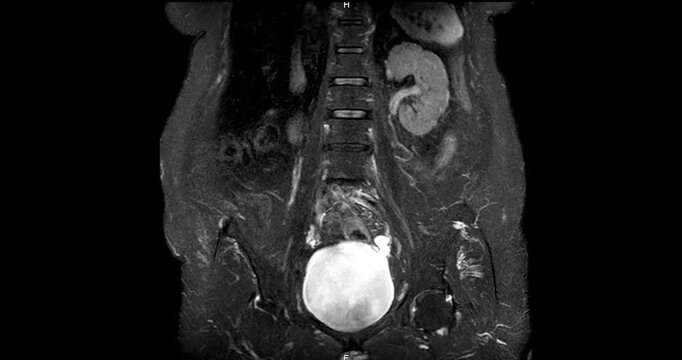 Medical video footage of an MRI lumbar spine scan revealing lumbar spondylosis and a herniated disc at the L3-L4 level. Perfect for healthcare, neurology, and orthopedic diagnostic concepts.