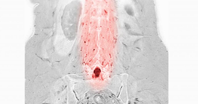 Medical video footage of an MRI lumbar spine scan revealing lumbar spondylosis and a herniated disc at the L3-L4 level. Perfect for healthcare, neurology, and orthopedic diagnostic concepts.