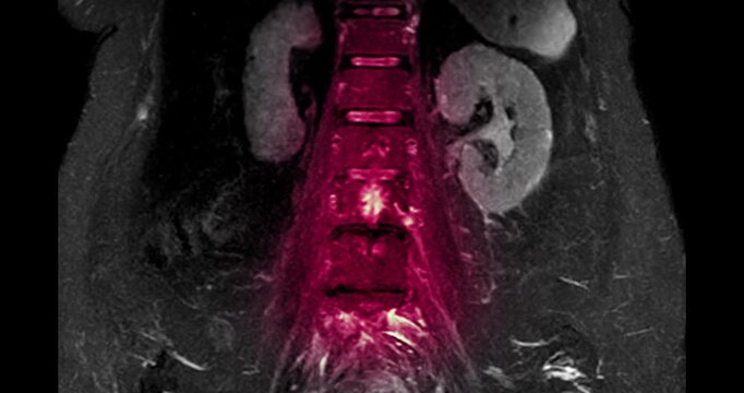 Medical video footage of an MRI lumbar spine scan revealing lumbar spondylosis and a herniated disc at the L3-L4 level. Perfect for healthcare, neurology, and orthopedic diagnostic concepts.