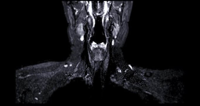 Magnetic resonance imaging (MRI) of a healthy human cervical spine and brachial plexus. Normal medical scan showing no spinal canal stenosis or nerve compression. Ideal for healthcare concepts.
