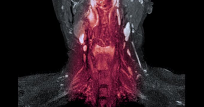 Magnetic resonance imaging (MRI) of a healthy human cervical spine and brachial plexus. Normal medical scan showing no spinal canal stenosis or nerve compression. Ideal for healthcare concepts.