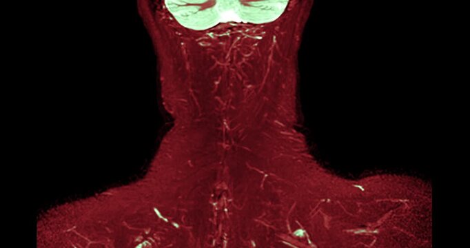 Magnetic resonance imaging (MRI) of a healthy human cervical spine and brachial plexus. Normal medical scan showing no spinal canal stenosis or nerve compression. Ideal for healthcare concepts.