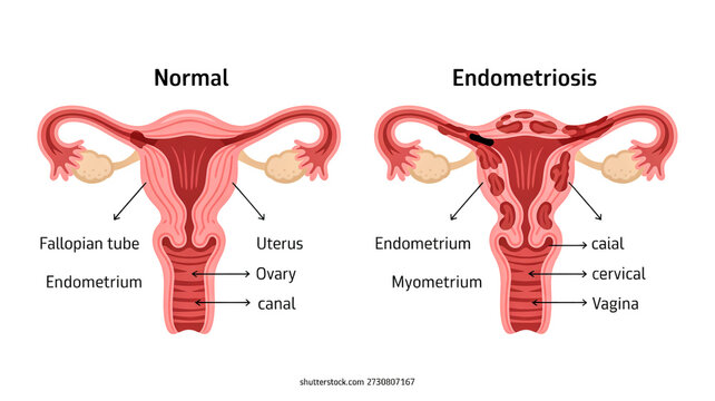 Medical illustration compares normal female reproductive system with endometriosis