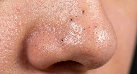 Fototapeta premium Macro Skin Texture Showing Enlarged Pores and Blackheads.