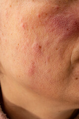 Naklejka premium Red rash eczema on a woman face due to liver disease , close up texture