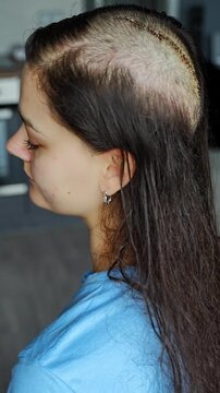 Woman with visible surgical scar after brain cancer surgery. Brain tumor treatment, oncology recovery and survival concept.